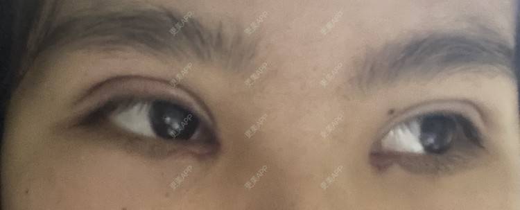 更美 - 更美用户LlGf9K7w9y的眼部多项经验 | 青岛 | 眼部多项