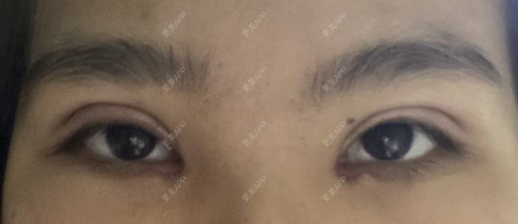 更美 - 更美用户LlGf9K7w9y的眼部多项经验 | 青岛 | 眼部多项