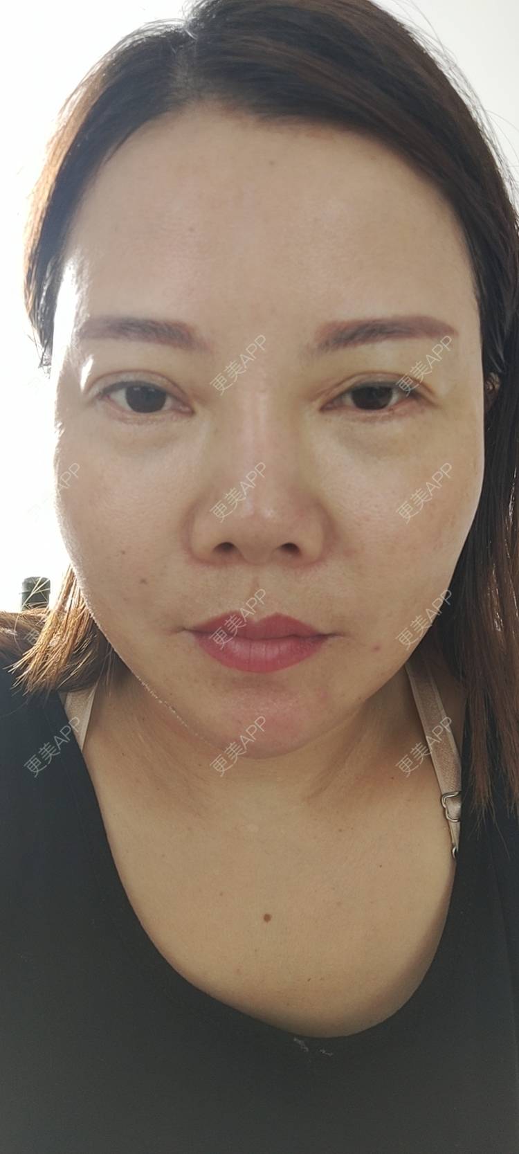 更美 - 更美用户xZI1wSP5Ch的隆鼻经验 | 隆鼻 | 肋软骨隆鼻 | 自体肋软骨垫鼻基底 | 上海