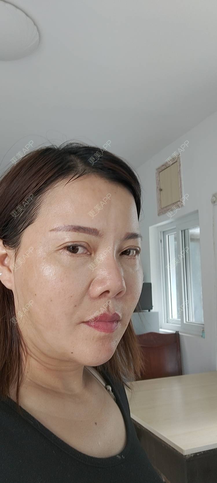 更美 - 更美用户xZI1wSP5Ch的隆鼻经验 | 隆鼻 | 肋软骨隆鼻 | 自体肋软骨垫鼻基底 | 上海