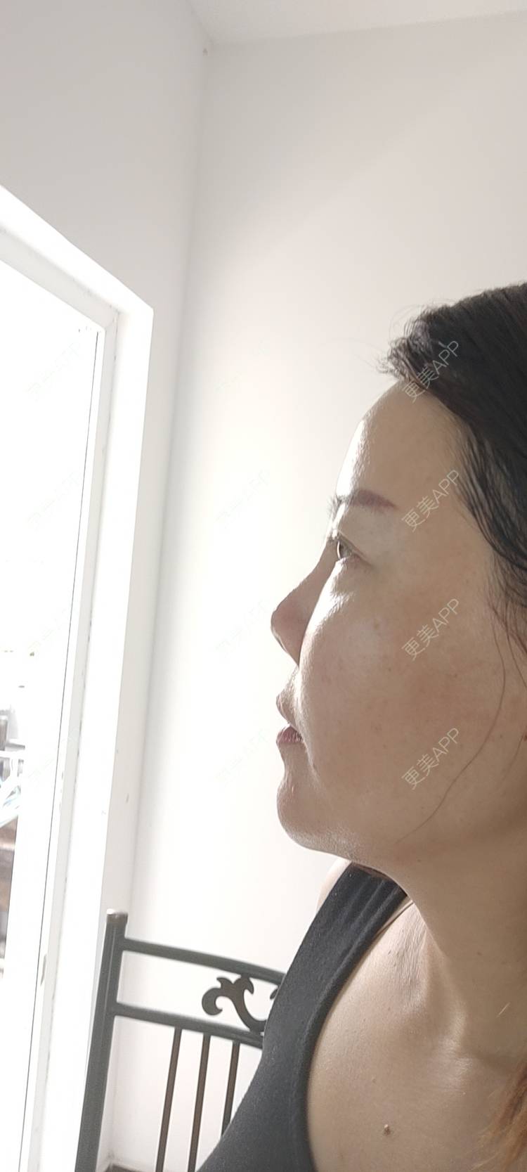 更美 - 更美用户xZI1wSP5Ch的隆鼻经验 | 隆鼻 | 肋软骨隆鼻 | 自体肋软骨垫鼻基底 | 上海