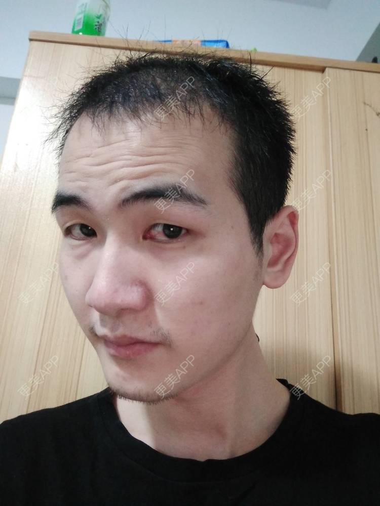 更美 - 更美用户wHSFRCieMm的植胡须经验 | 武汉 | 植胡须