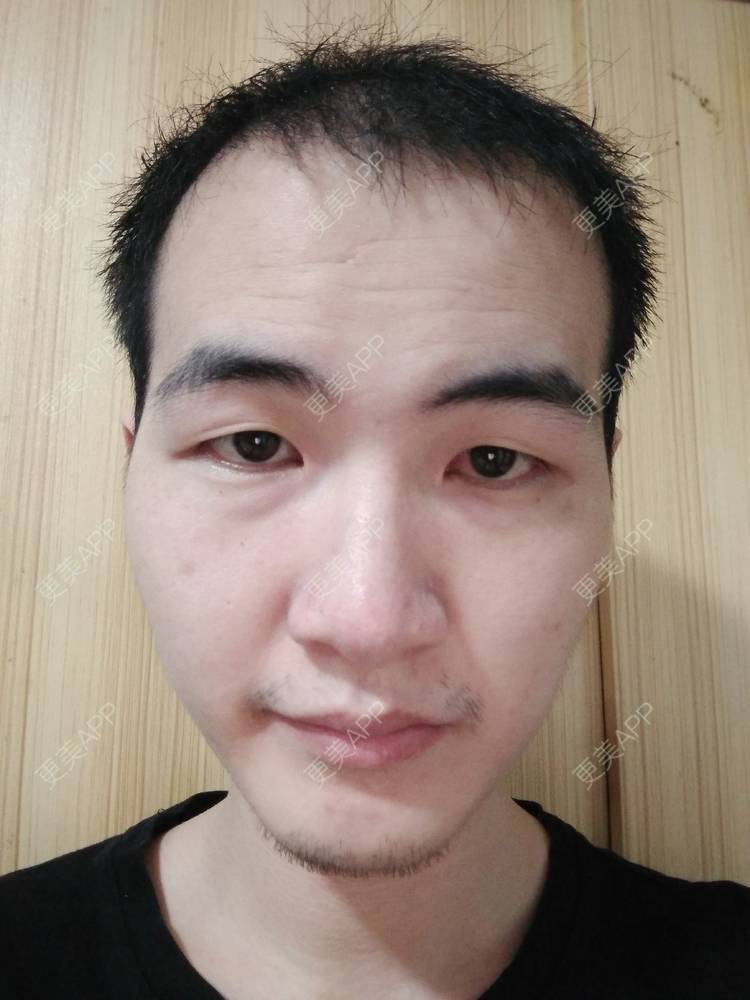 更美 - 更美用户wHSFRCieMm的植胡须经验 | 武汉 | 植胡须