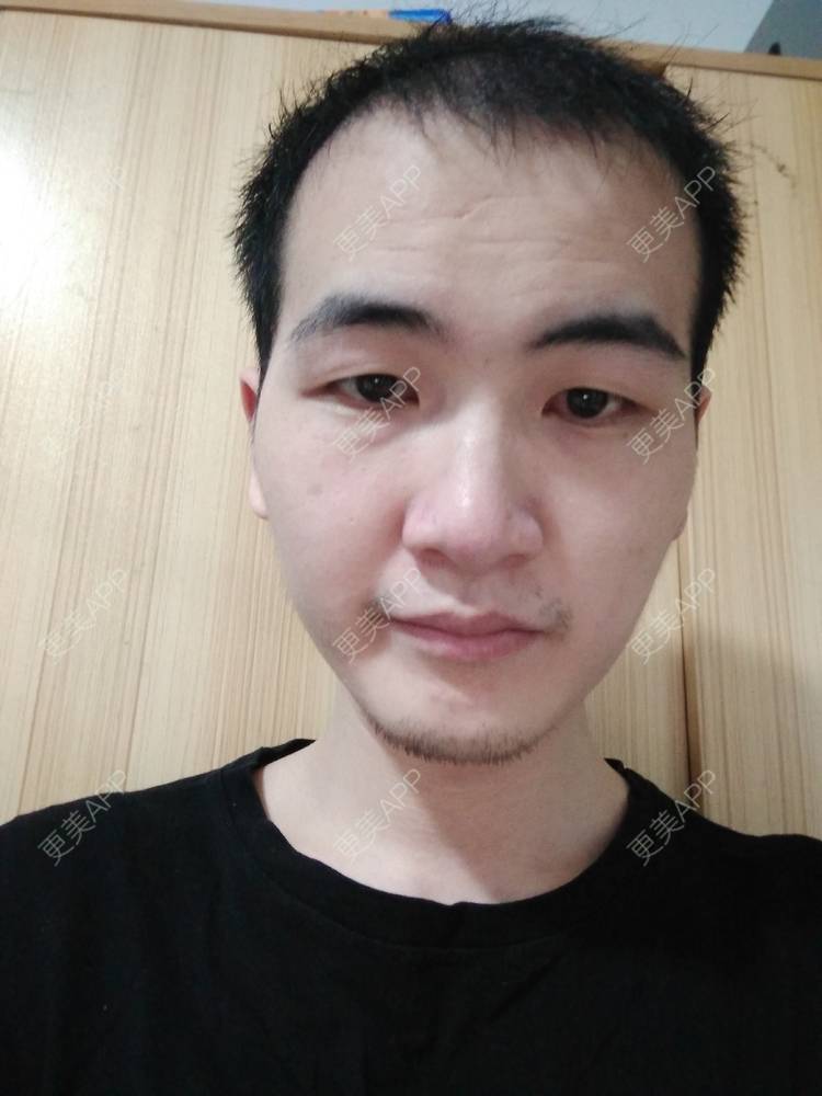 更美 - 更美用户wHSFRCieMm的植胡须经验 | 武汉 | 植胡须