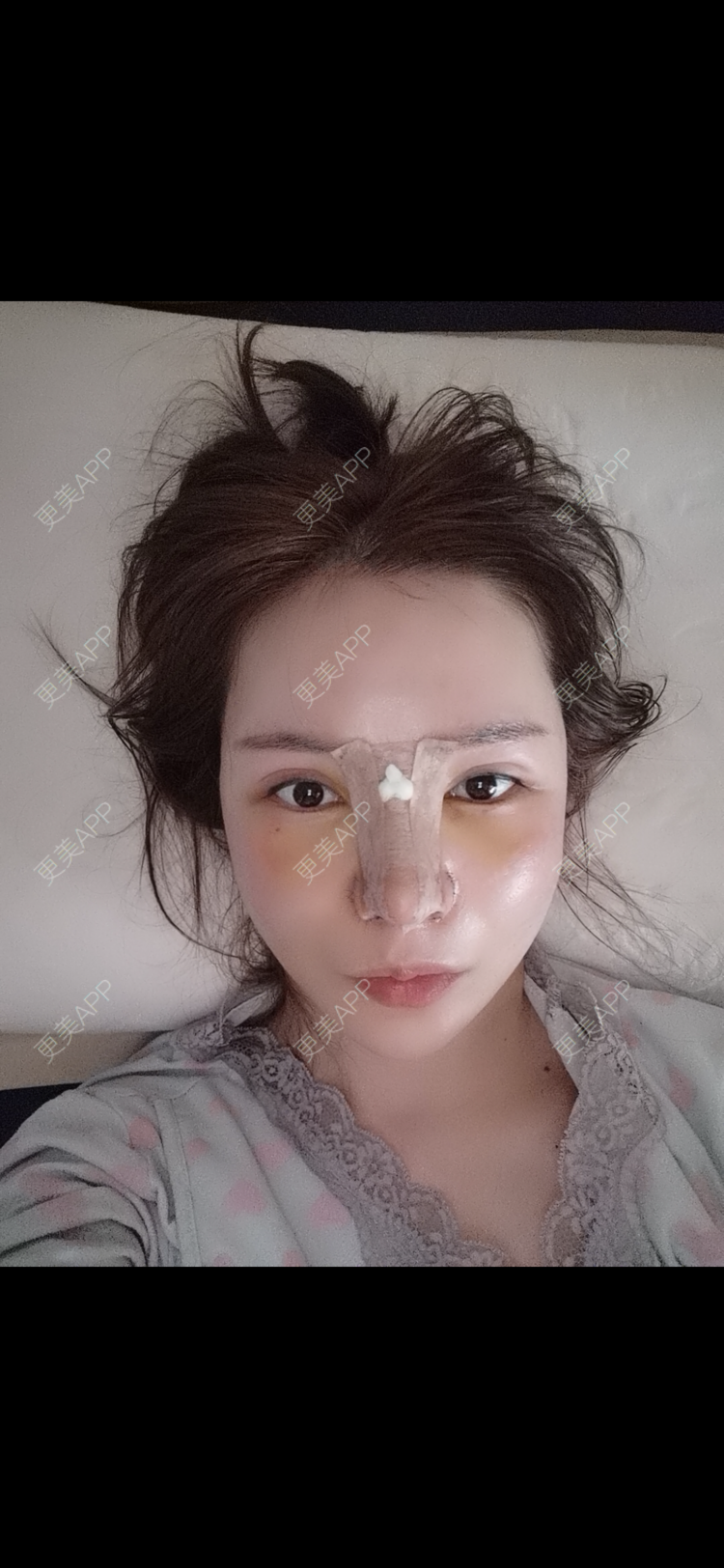 更美 - 毛菇小象的真皮隆鼻经验 | 真皮隆鼻 | 西安