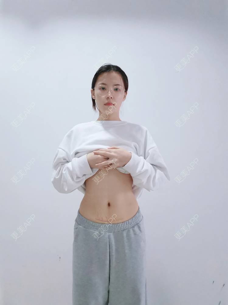 更美 - 更美用户x44KhGeKO3的剖腹产手术经验 | 激光淡疤 | 剖腹产手术 | 激光淡化妊娠纹 | 产后修复 | 成都