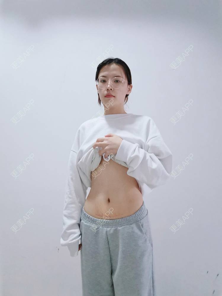 更美 - 更美用户x44KhGeKO3的剖腹产手术经验 | 激光淡疤 | 剖腹产手术 | 激光淡化妊娠纹 | 产后修复 | 成都