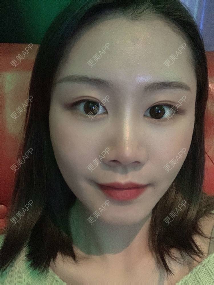 更美 - 喵咩咩胀的胶原蛋白丰面颊经验 | 北京 | 胶原蛋白丰面颊
