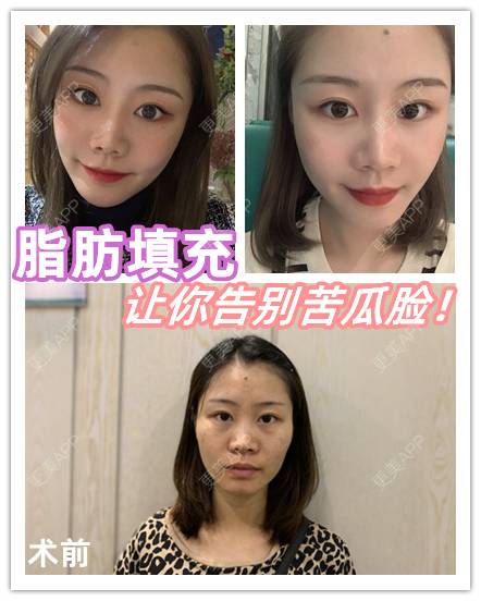 更美 - 喵咩咩胀的胶原蛋白丰面颊经验 | 北京 | 胶原蛋白丰面颊