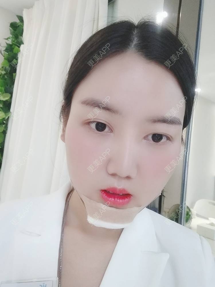 更美 - 陶三岁的硅胶垫下巴经验 | 硅胶垫下巴 | 襄阳