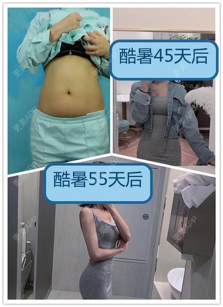 更美 - 更美用户mMsAkNZELQ的冷冻减脂瘦腹部经验 | 冷冻减脂瘦腹部 | 冷冻减脂瘦大腿 | 重庆