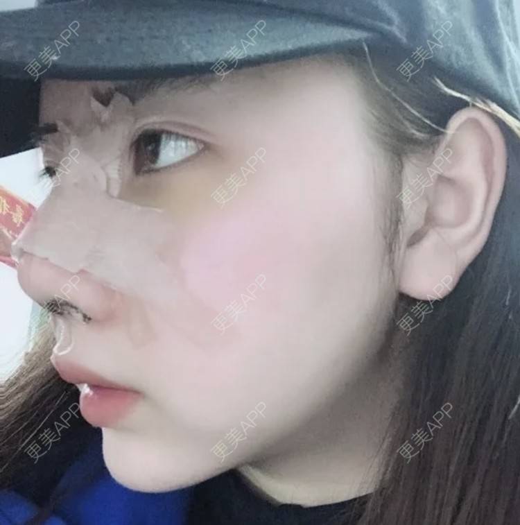 更美 - 知心人哟的鼻部多项经验 | 鼻部多项 | 南昌