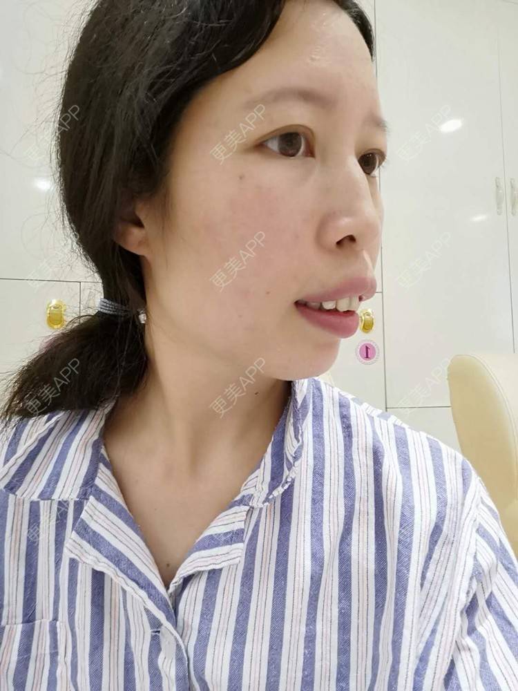 更美用户ujdprcuyhr的凸嘴矫正日记