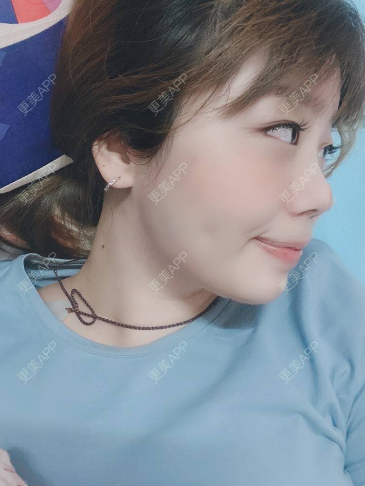 更美 - 更美用户xeNNAZTiuN的除皱瘦脸经验 | 除皱瘦脸 | 自体脂肪垫下巴 | 上海