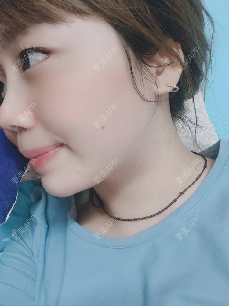 更美 - 更美用户xeNNAZTiuN的除皱瘦脸经验 | 除皱瘦脸 | 自体脂肪垫下巴 | 上海