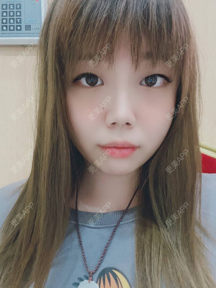 更美 - 更美用户xeNNAZTiuN的除皱瘦脸经验 | 除皱瘦脸 | 自体脂肪垫下巴 | 上海