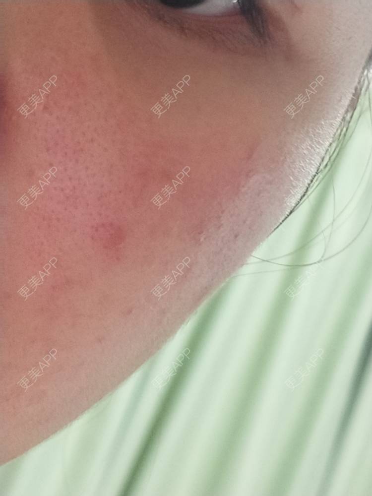 更美 - 鴘鴿的果酸焕肤经验 | 东莞 | 果酸焕肤