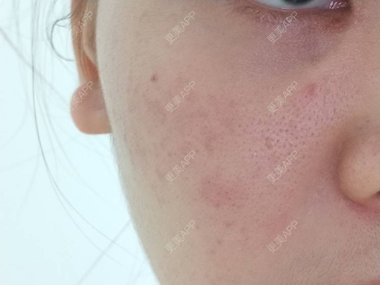 更美 - 鴘鴿的果酸焕肤经验 | 东莞 | 果酸焕肤