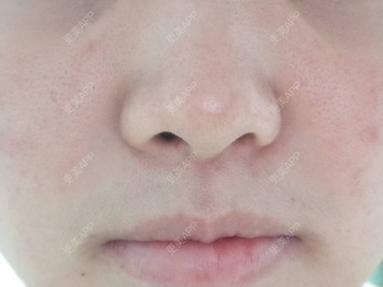 更美 - 鴘鴿的果酸焕肤经验 | 东莞 | 果酸焕肤