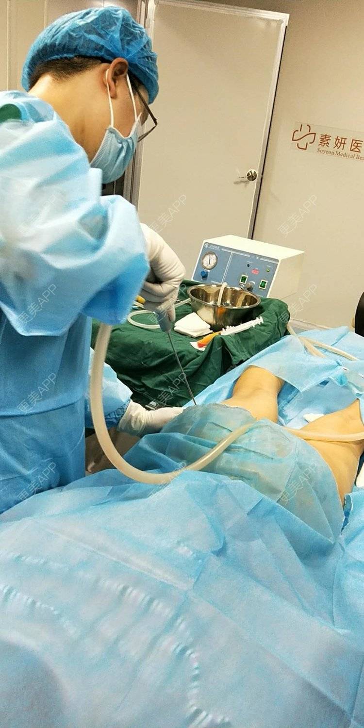 更美用户4b0xo8pu6d的全身吸脂日记