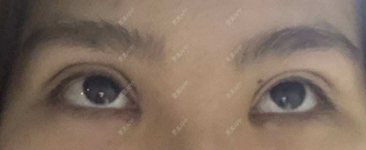 更美 - 更美用户LlGf9K7w9y的眼部多项经验 | 青岛 | 眼部多项