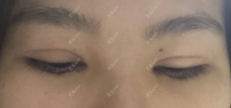 更美 - 更美用户LlGf9K7w9y的眼部多项经验 | 青岛 | 眼部多项