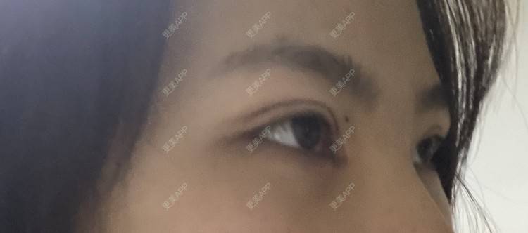 更美 - 更美用户LlGf9K7w9y的眼部多项经验 | 青岛 | 眼部多项