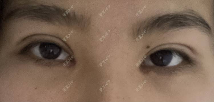 更美 - 更美用户LlGf9K7w9y的眼部多项经验 | 青岛 | 眼部多项