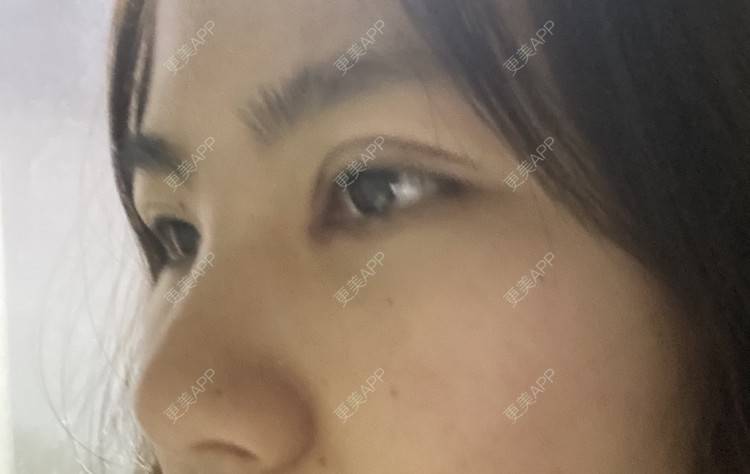更美 - 更美用户LlGf9K7w9y的眼部多项经验 | 青岛 | 眼部多项