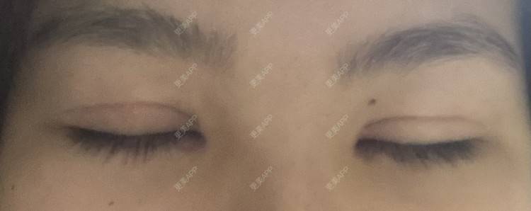 更美 - 更美用户LlGf9K7w9y的眼部多项经验 | 青岛 | 眼部多项