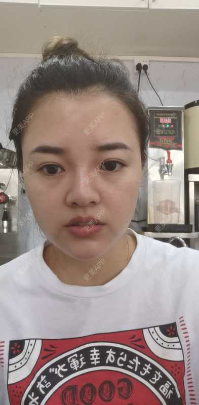 更美 - 狗友你宣么柏的下巴经验 | 下巴 | 吸脂瘦脸 | 双下巴吸脂 | 北京