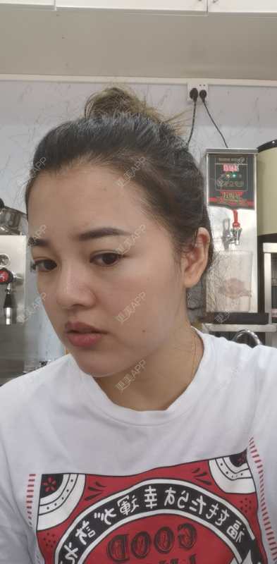 更美 - 狗友你宣么柏的下巴经验 | 下巴 | 吸脂瘦脸 | 双下巴吸脂 | 北京