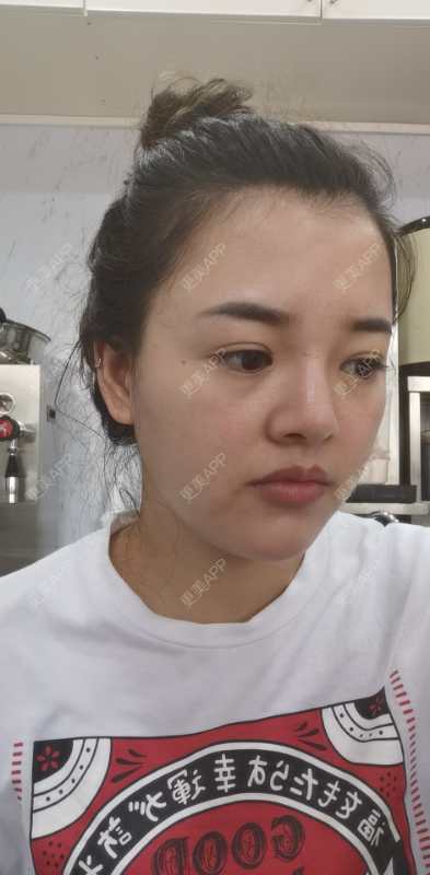 更美 - 狗友你宣么柏的下巴经验 | 下巴 | 吸脂瘦脸 | 双下巴吸脂 | 北京