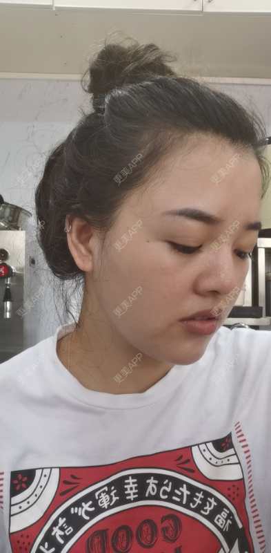 更美 - 狗友你宣么柏的下巴经验 | 下巴 | 吸脂瘦脸 | 双下巴吸脂 | 北京