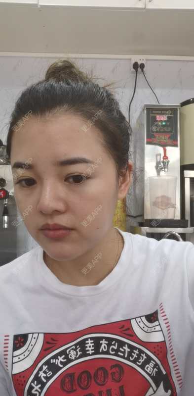 更美 - 狗友你宣么柏的下巴经验 | 下巴 | 吸脂瘦脸 | 双下巴吸脂 | 北京