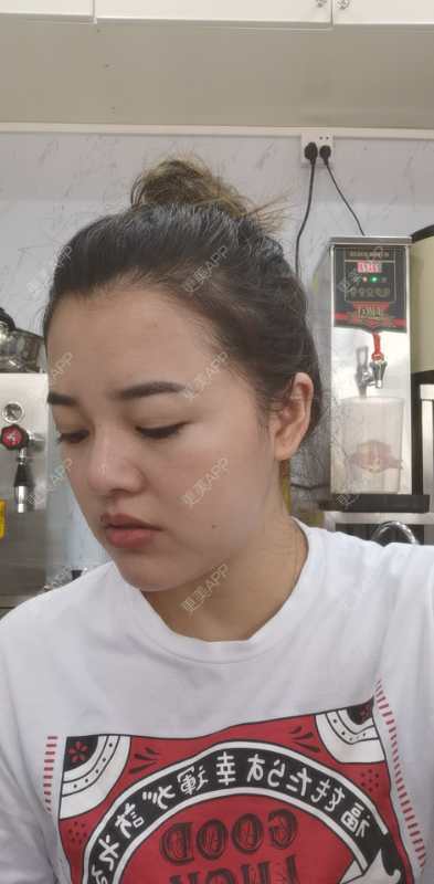 更美 - 狗友你宣么柏的下巴经验 | 下巴 | 吸脂瘦脸 | 双下巴吸脂 | 北京