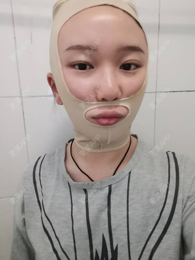 更美 - baby熊熊的颧骨内推日记 | 颧骨内推 | 颧骨颧弓整形