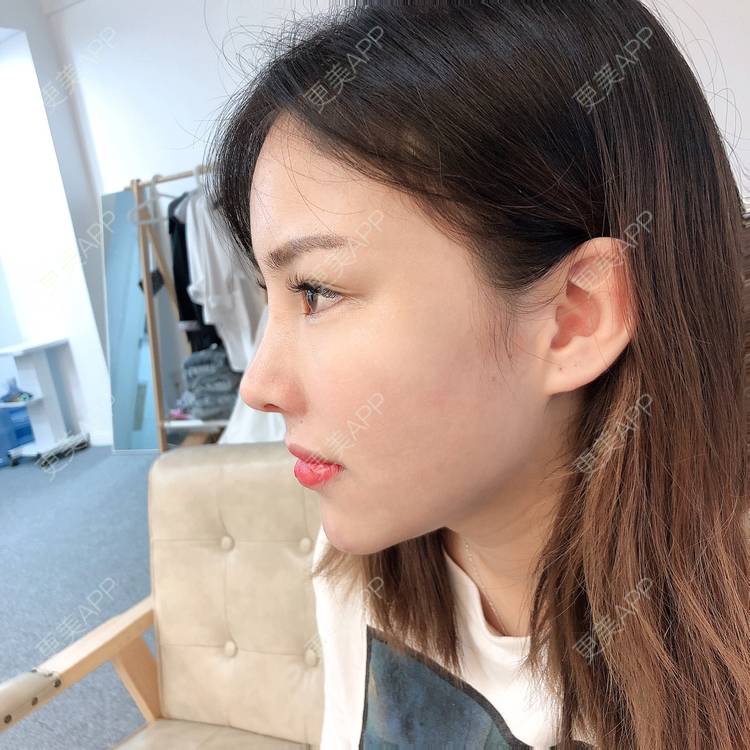 更美 - 更美用户URZfHp4iU0的肋软骨隆鼻经验 | 成都 | 肋软骨隆鼻