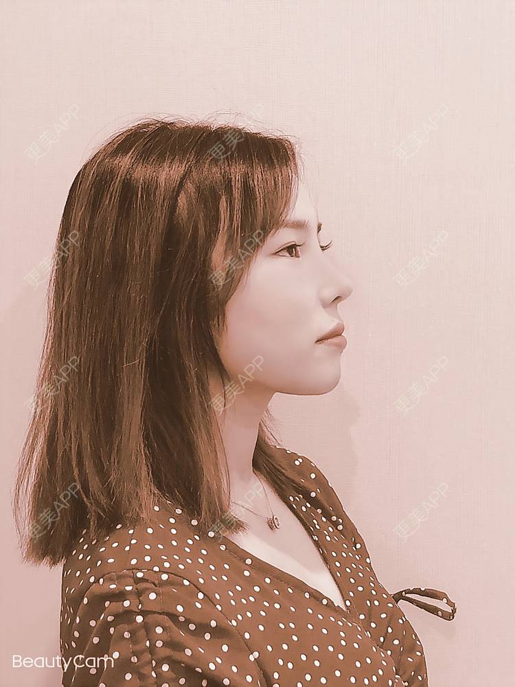 更美 - 更美用户URZfHp4iU0的肋软骨隆鼻经验 | 成都 | 肋软骨隆鼻