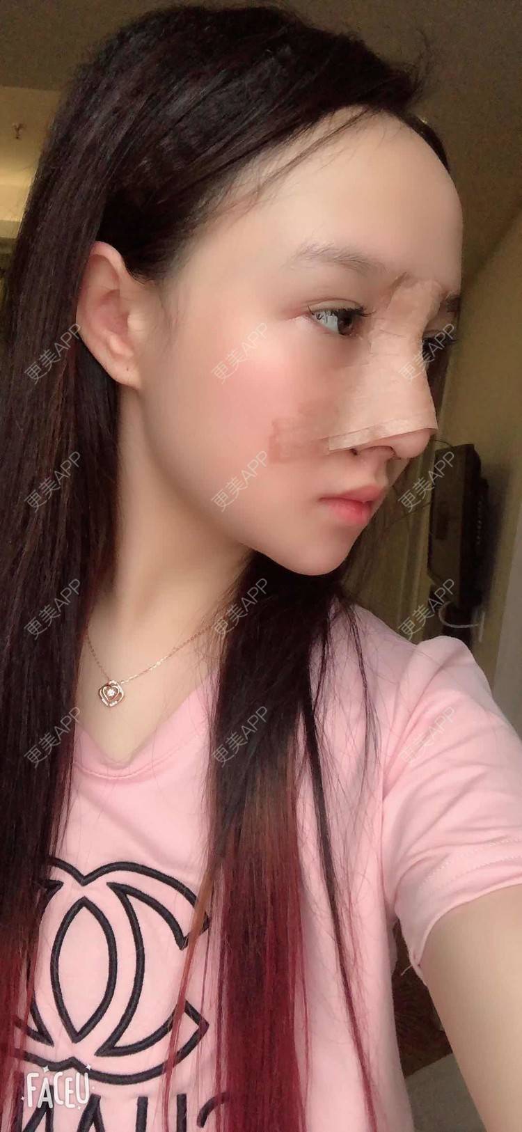 更美用户ma6zhfjljv的肋软骨隆鼻日记