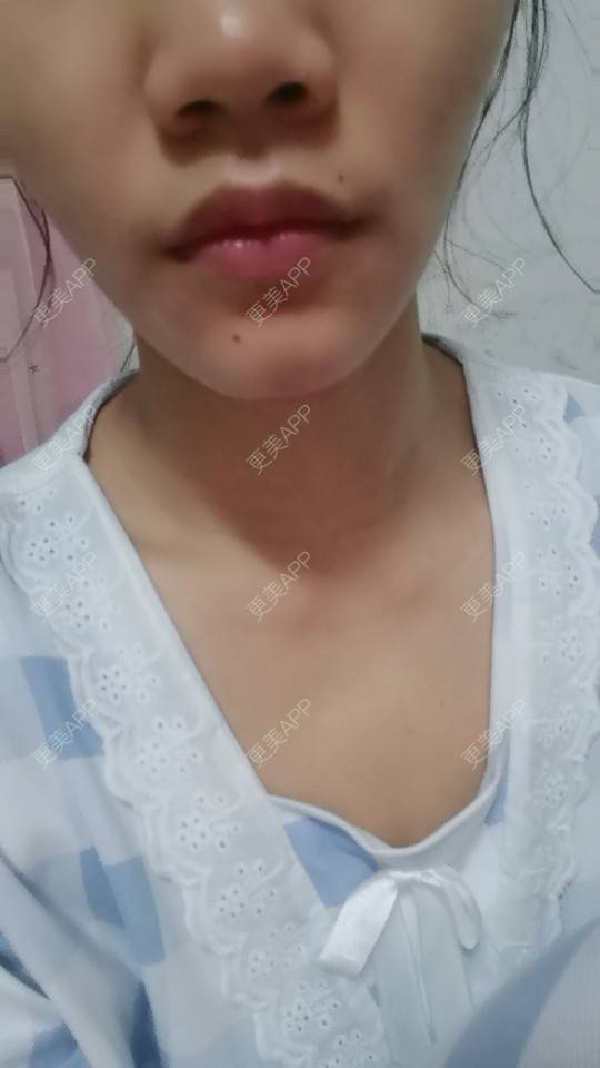 更美 -  是我呀！🌹的M唇成形经验 | 深圳 | M唇成形
