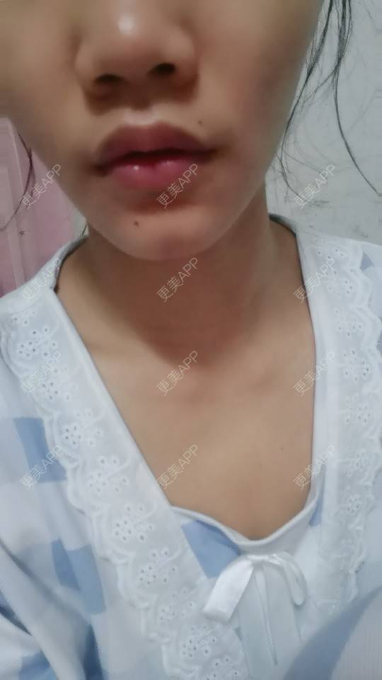 更美 -  是我呀！🌹的M唇成形经验 | 深圳 | M唇成形