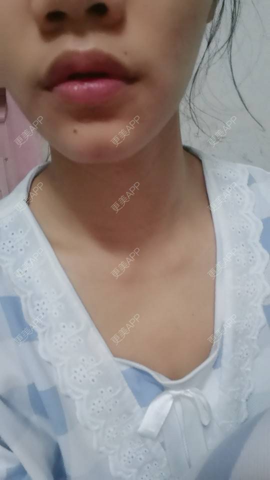 更美 -  是我呀！🌹的M唇成形经验 | 深圳 | M唇成形