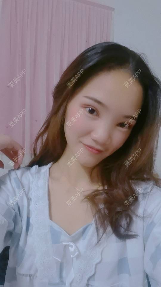 更美 -  是我呀！🌹的M唇成形经验 | 深圳 | M唇成形