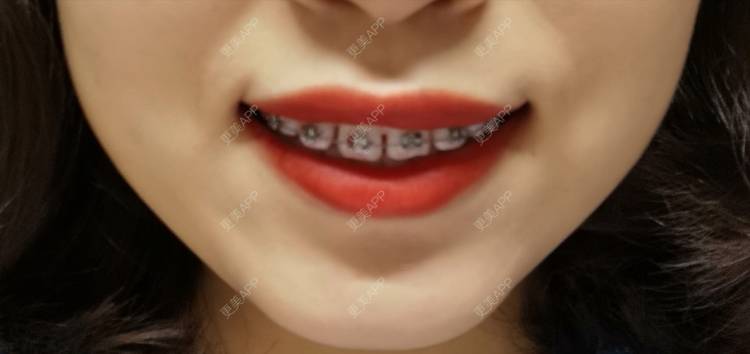 更美 - 更美用户YWdQyE2kiR的金属托槽矫正经验 | 北京 | 金属托槽矫正