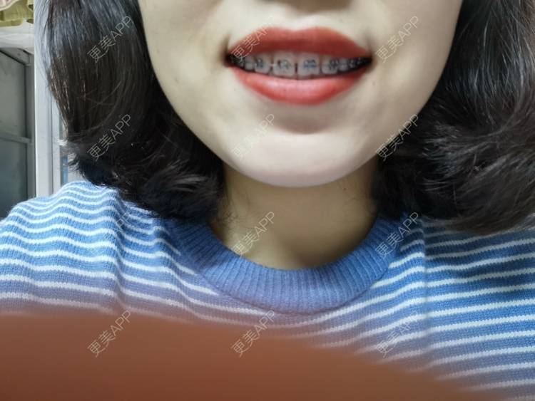 更美 - 更美用户YWdQyE2kiR的金属托槽矫正经验 | 北京 | 金属托槽矫正