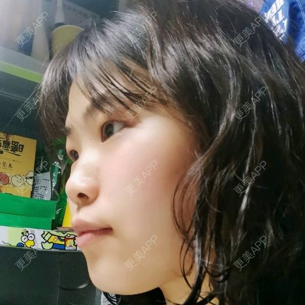 更美 - 更美用户YWdQyE2kiR的金属托槽矫正经验 | 北京 | 金属托槽矫正