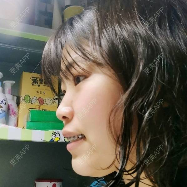 更美 - 更美用户YWdQyE2kiR的金属托槽矫正经验 | 北京 | 金属托槽矫正