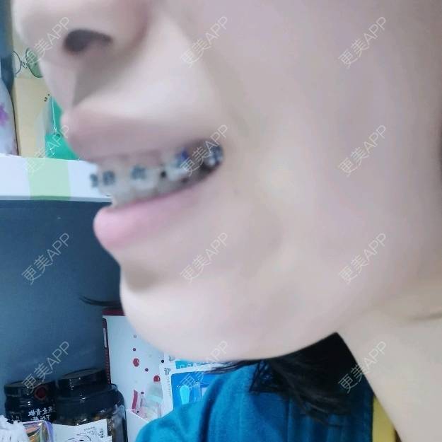 更美 - 更美用户YWdQyE2kiR的金属托槽矫正经验 | 北京 | 金属托槽矫正
