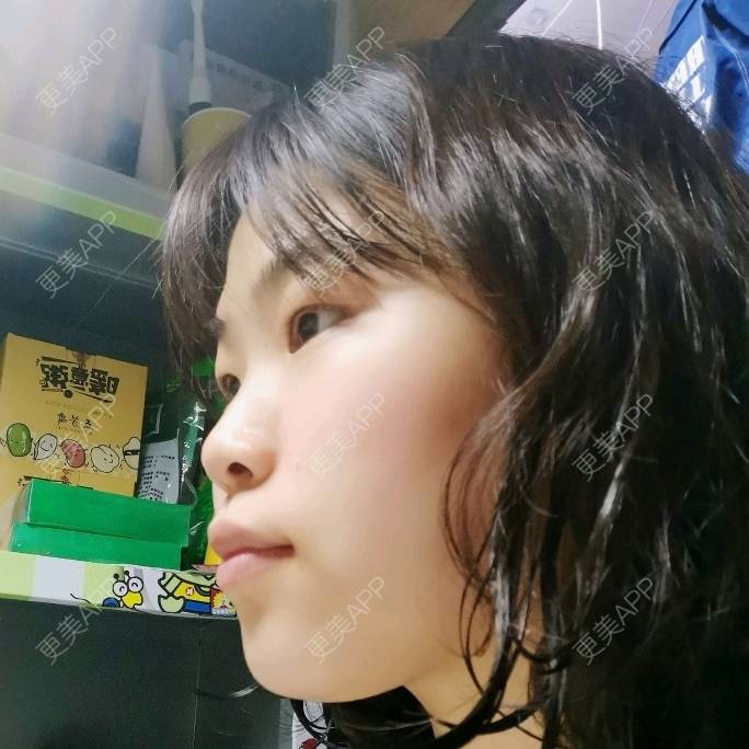 更美 - 更美用户YWdQyE2kiR的金属托槽矫正经验 | 北京 | 金属托槽矫正